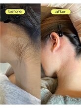 レビア(Revia)/気になるうなじも即日スッキリ☆