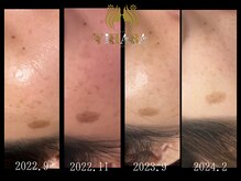 ビハーラ 門司店/シミケア