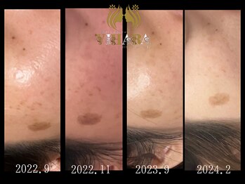 ビハーラ 門司店/シミケア