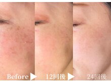 アリエルリッチ/【美肌ケア】Before左→After右