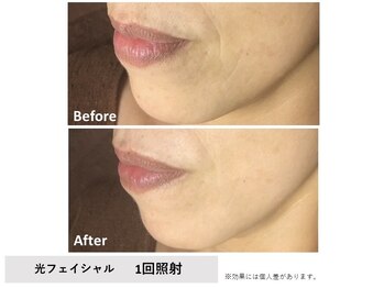 メイ(meiy)/たるみ/しわ/美白/毛穴