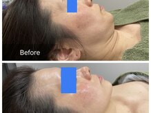 トータルビューティ リライフ(Total beauty Relife)/ハーブピーリングよもぎ蒸し