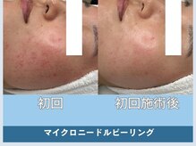 アロマ(AROMA)/赤ニキビケア/毛穴/越谷