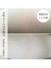 ココスターリー 香椎店(Coco starry)/女性・照射3回☆1ヶ月後