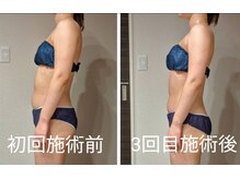 姿勢改善＆痩身効果を高める施術をするから気になるお腹にも◎