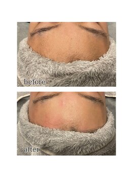 アデル 久留米(ADEL)/おでこ脱毛