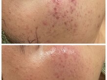 トータルビューティ リライフ(Total beauty Relife)/水素水ピーリング毛穴洗浄光美容