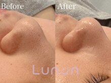 ルノン(Lunon)/毛穴洗浄ハイドロ