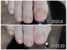 爪切り屋 足楽/【爪の変形】