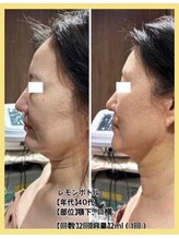 リファイン(REFINE)/小顔効果◎レモンボトル