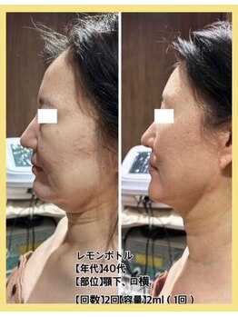 リファイン(REFINE)/小顔効果◎レモンボトル