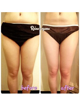 レーヌ青山(Reine Aoyama)/【施術】インディバでスリム美人