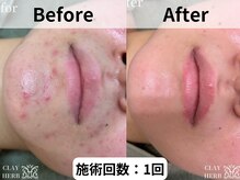 ナナ(nana)/ハーブピーリング｜ニキビケア