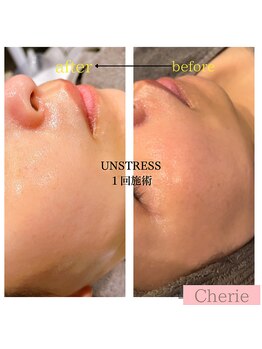 シェリー(Cherie)/UNSTRESS乳酸菌ピーリング