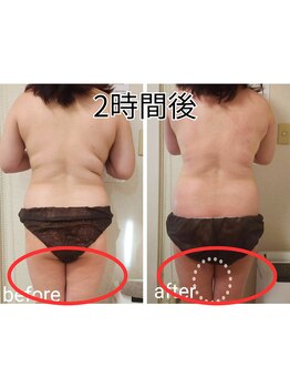 レニフォーメン(reni for men)/【とりずらい内もも肉】