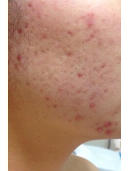 スキンケアスタジオ アコ 新宿店(Aco)/GPソフト１Dのお客様