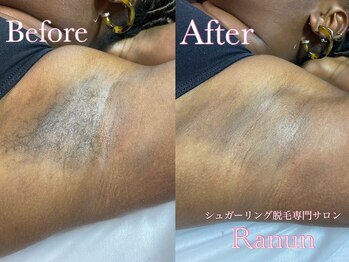ラナン(Ranun)/脇のムダ毛ももう気にならない!