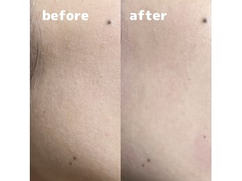 リノア(Linoa)/まつぱの合間でワックス脱毛