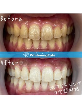 ホワイトニングカフェ 池袋東口店/ホワイトニングビフォーアフター
