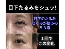目元 口元のたるみ 眉間シワ改善専門サロン