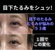 目元 口元のたるみ 眉間シワ改善専門サロン