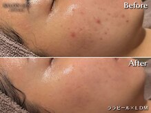 サロン ド エス アオヤマ(SALON DE S AOYAMA)の雰囲気（ララピール×LDMでニキビ対策！内側から光放つ、驚きの透明感）