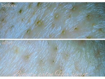 ハーシークレット(Her secret)/ハイドラ毛穴洗浄