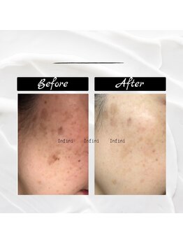 アンフィニ 麻布十番(Infini)/ハーブピーリング/NPVA