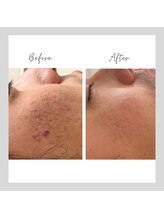 キラリス(Kilaris)/《ハーブで男性お肌も改善☆》