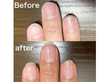 深爪矯正で指先コンプレックス解消！カラーやデザイン仕上げ可◎