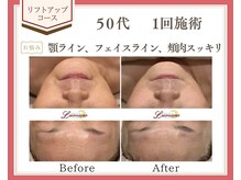 リュミエール(Lumiere)/【症例】たるみ改善コース