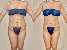 カルナ(CARNA)/【痩身】セルライトゼロ2