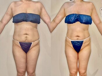 カルナ(CARNA)/【痩身】セルライトゼロ2