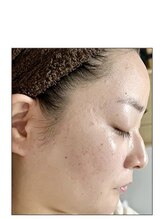 ノーブル 新宿南口(NOBLE)/ハーブピーリング専門新宿