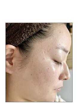 ノーブル 新宿南口(NOBLE)/ハーブピーリング専門新宿