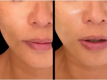 ジーニー(Genie)/ララピール