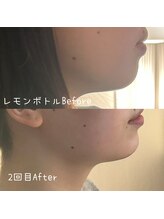 サロン ド モミカル(salon de momikaru)/レモンボトル