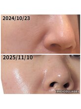 ウィズユー(with U)/ハーブ1年30代毛穴変化