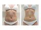 ミーシェ(Meshie)の写真/北陸初導入！寝るだけ30分２万回の筋トレで我慢なし運動なしでサイズダウン◎骨盤底筋も鍛えてくびれ美人♪
