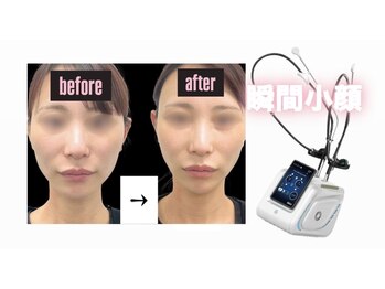 アテ(Ate)の写真/韓国最新『マイクロウェーブリフト』で最新小顔、たるみ、口横ぽにょ肉に◎