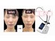アテ(Ate)の写真/韓国最新『マイクロウェーブリフト』で最新小顔、たるみ、口横ぽにょ肉に◎