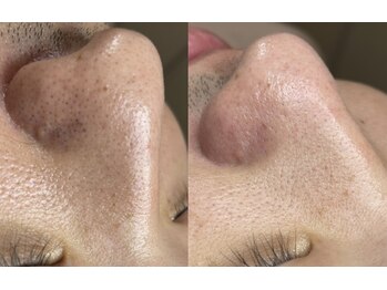 ビオプラス(BIO PLUS)/【毛穴】毛穴エクストラクション