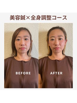 ベルソー鍼灸整体院(berceau鍼灸整体院)/美容はり×根本改善30代女性