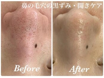 ルアナアイナ(Luana Aina)/ハーブピーリングで毛穴ケア