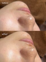 オアシス メイエキ(Oasis ｍeieki)/【水素毛穴洗浄】