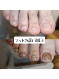 フットの深爪矯正で足美人に