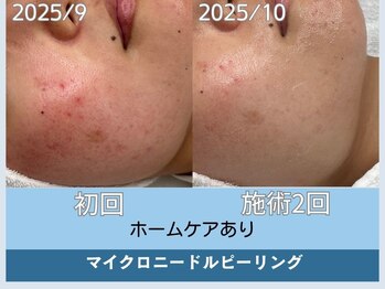 アロマ(AROMA)/赤ニキビケア/毛穴/越谷