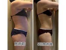 クールスパ(COOL SPA)/【30代女性】お腹症例