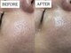 オンフリーク(ON FLEEK)の写真/「肌の凹凸や毛穴を何とかしたい」をダウンタイムや痛みほぼなしで叶える！！【エステ版ダーマ】