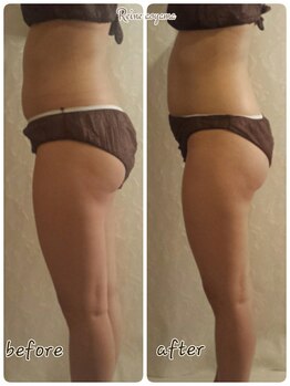 レーヌ青山(Reine Aoyama)/【施術】インディバで脂肪燃焼